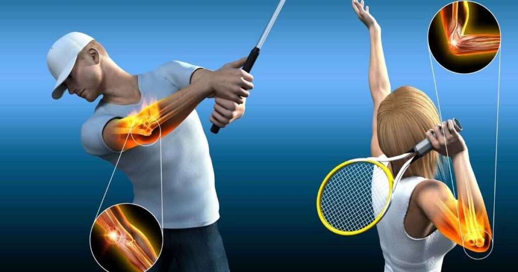 Epicondilitis síntomas, causas y tratamiento del codo